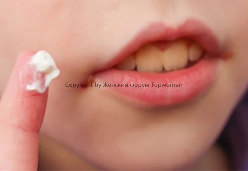 Чем лечить заеды на губах у детей